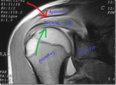 shoulder impingement shoulder impingement